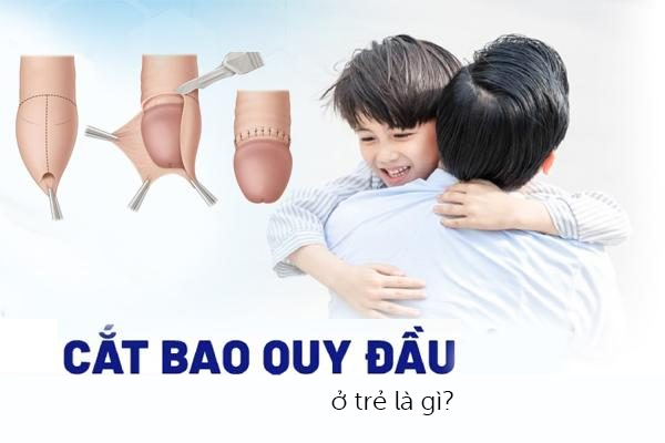 Cắt bao quy đầu ở trẻ là gì?