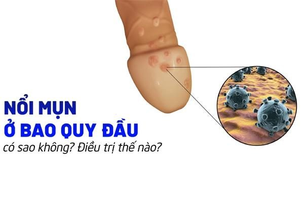 Nổi mụn bao quy đầu có sao không? Điều trị như thế nào?