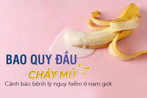 Chảy mủ ở bao quy đầu – Cảnh báo bệnh lý nguy hiểm ở nam giới