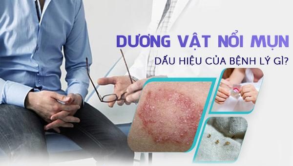 Dương vật nổi mụn là dấu hiệu của bệnh lý gì?