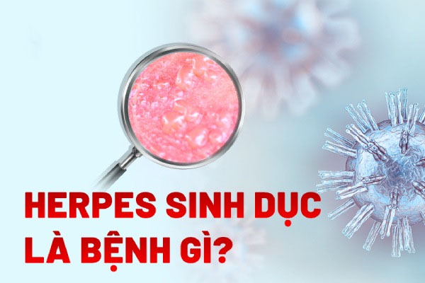 Bệnh Herpes sinh dục là bệnh gì?