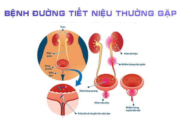 Bệnh đường tiết niệu thường gặp là bệnh gì?