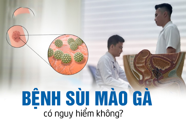 Bệnh sùi mào gà có nguy hiểm không?