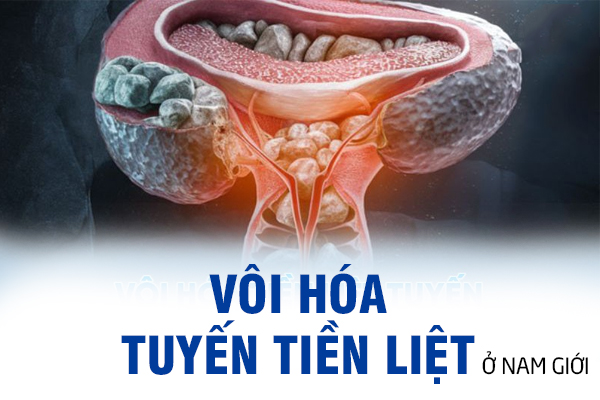 Bệnh vôi hoá tuyến tiền liệt ở nam giới