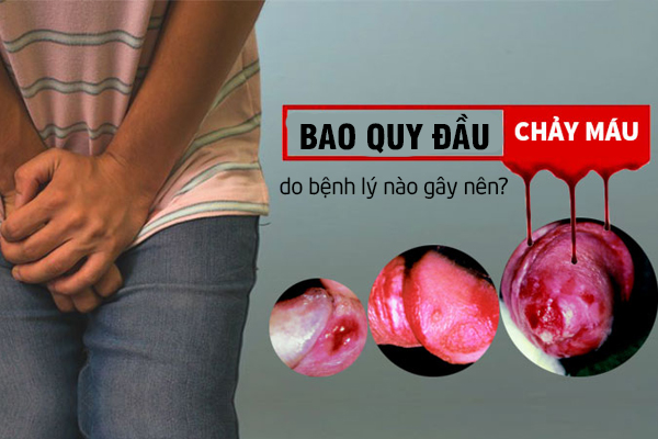Chảy máu bao quy đầu do bệnh lý nào gây nên?