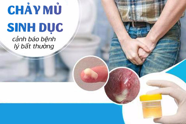 Chảy mủ ở sinh dục cảnh báo bệnh lý bất thường