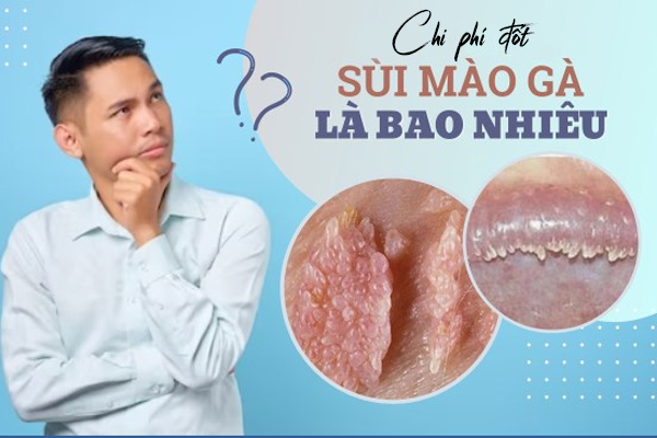 Đốt sùi mào gà và chi phí bao nhiêu?