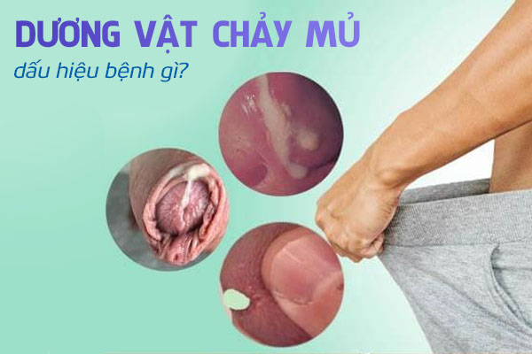 Dương vật chảy mủ là dấu hiệu bệnh gì?