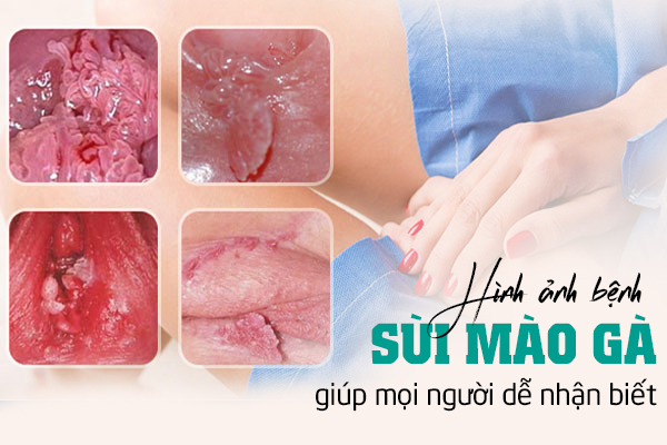 Nhận biết hình ảnh sùi mào gà