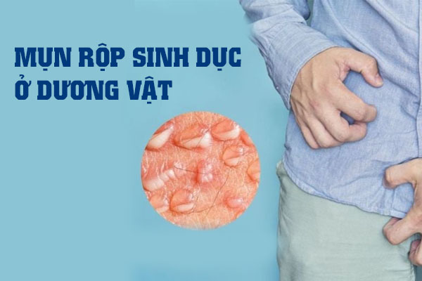 Mụn rộp sinh dục ở dương vật