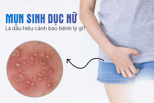 Mụn sinh dục nữ là dấu hiệu cảnh báo bệnh lý gì? 