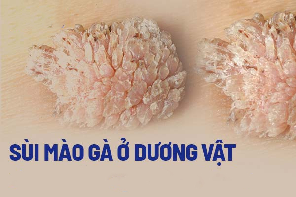 Nhận biết sùi mào gà ở dương vật