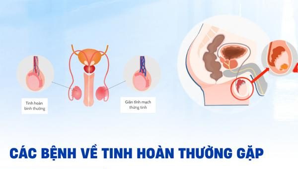 Những bệnh tinh hoàn thường gặp ở nam giới