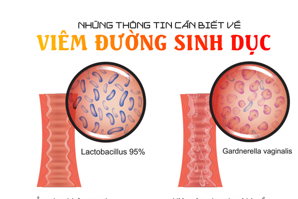 Những thông tin cần biết về bệnh viêm đường sinh dục