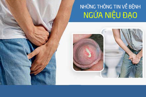 Những thông tin về bệnh ngứa niệu đạo