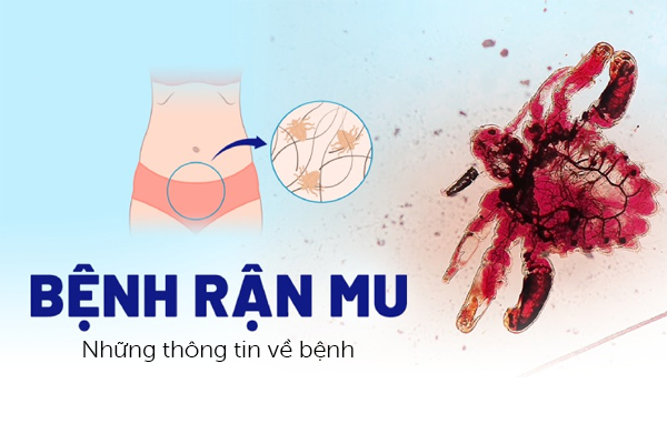 Những thông tin về bệnh rận mu