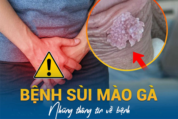 Những thông tin về bệnh sùi mào gà