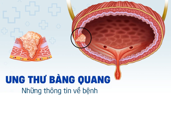 Những thông tin về bệnh ung thư bàng quang