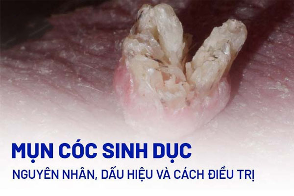 Mụn cóc sinh dục nguy hiểm ra sao