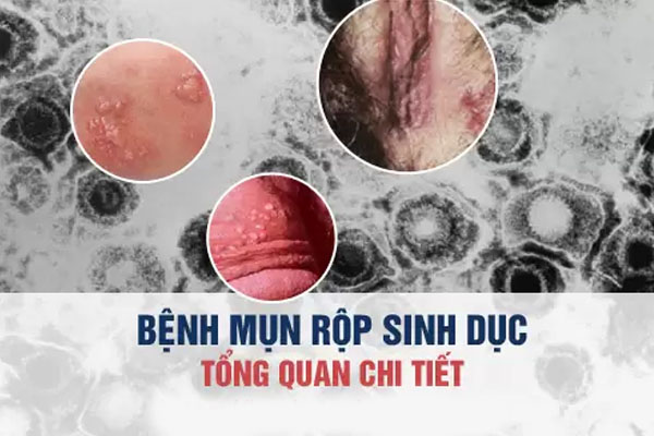 Những thông tin về mụn rộp sinh dục