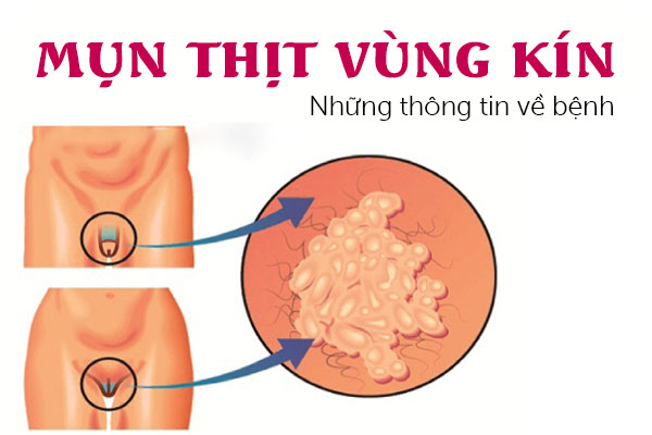 Những thông tin về mụn thịt vùng kín