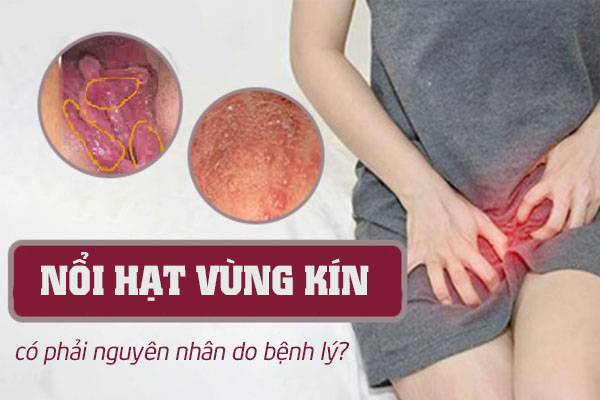 Nổi hạt vùng kín có phải nguyên nhân do bệnh lý?