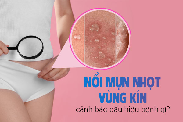 Nổi mụn nhọt vùng kín cảnh báo dấu hiệu bệnh gì?