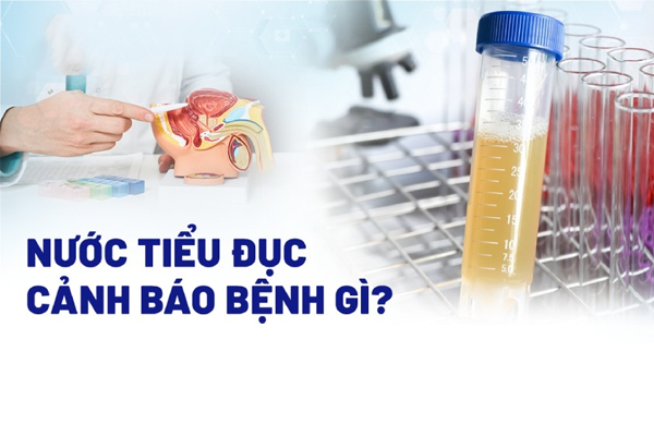 Nước tiểu đục là dấu hiệu của bệnh lý gì?
