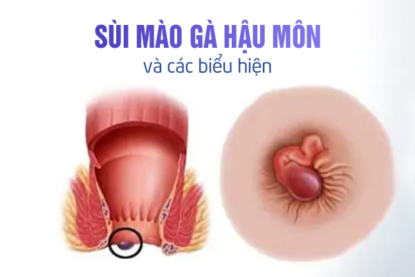 Sùi mào gà ở hậu môn và các biểu hiện