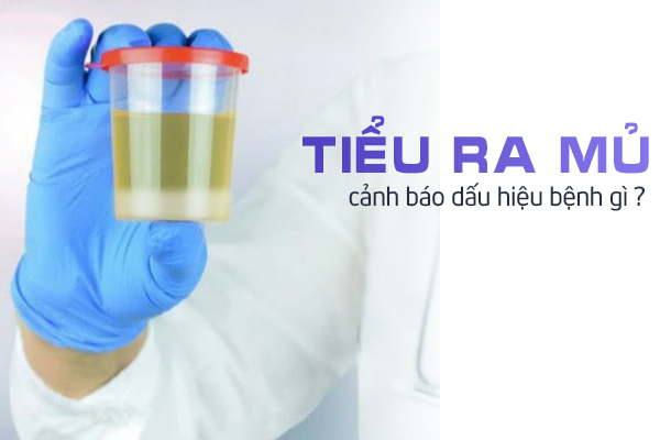 Tiểu ra mủ cảnh báo dấu hiệu bệnh gì?
