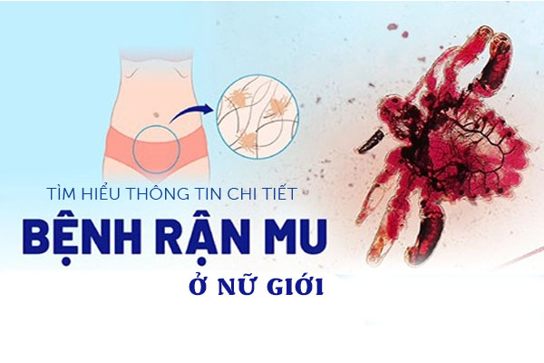 Tìm hiểu chi tiết thông tin bệnh rận mu ở nữ