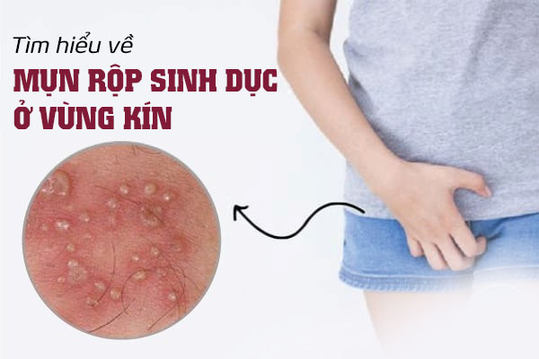 Tìm hiểu mụn rộp sinh dục ở vùng kín