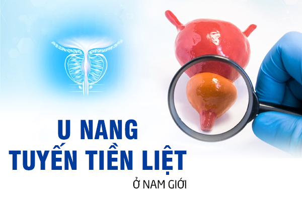 Tìm hiểu u nang tuyến tiền liệt ở nam giới