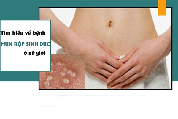 Tìm hiểu về bệnh mụn rộp sinh dục nữ