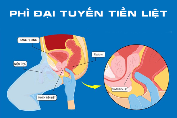 Tìm hiểu về bệnh phì đại tuyến tiền liệt