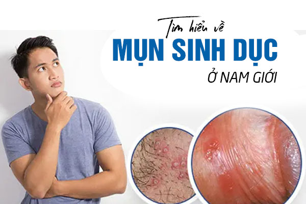 Tìm hiểu về mụn sinh dục nam giới