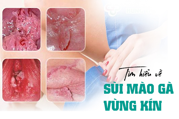 Tìm hiểu về sùi mào gà vùng kín