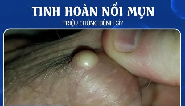 Tinh hoàn nổi mụn là triệu chứng bệnh gì?