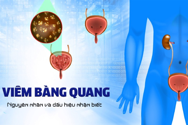 Viêm bàng quang: Nguyên nhân và dấu hiệu nhận biết