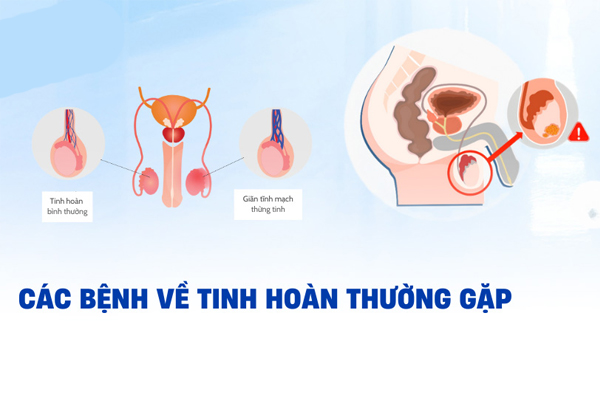 Điểm danh các bệnh tinh hoàn ở nam giới