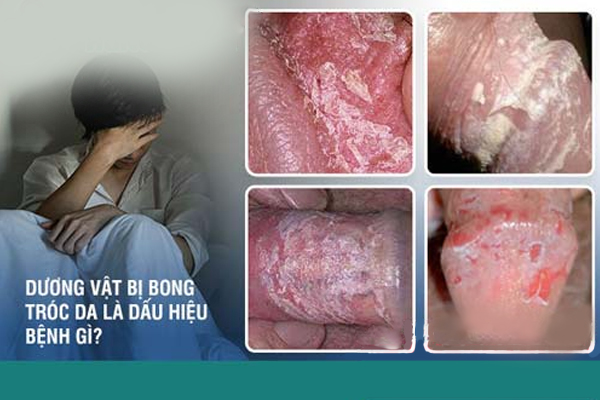 Dương vật/bao quy đầu bị tróc da là bị bệnh gì?