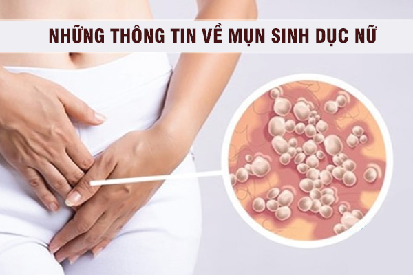 Những thông tin về mụn sinh dục nữ