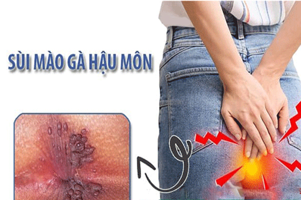 Thông tin về bệnh sùi mào gà ở hậu môn