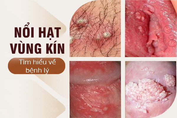 Tìm hiểu về bệnh lý nổi hạt vùng kín