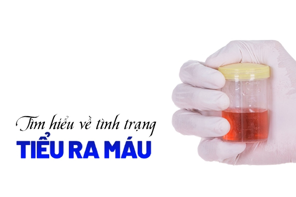 Tìm hiểu về tình trạng tiểu ra máu