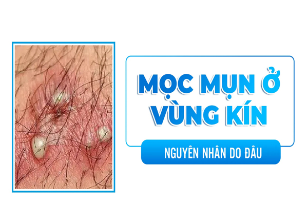Bị mọc mụn nước vùng kín là do đâu?