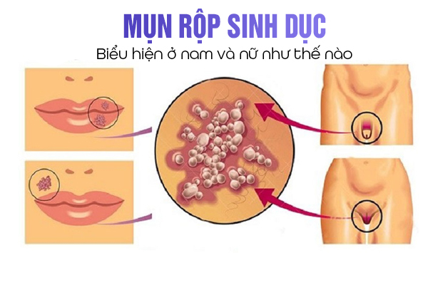 Biểu hiện mụn rộp sinh dục ở nam và nữ như thế nào?