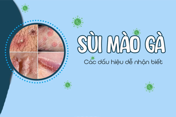 Các dấu hiệu sùi mào gà dễ nhận biết
