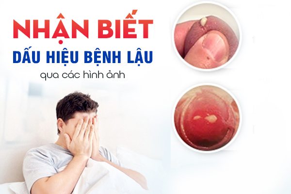 Nhận biết dấu hiệu bệnh lậu qua các hình ảnh