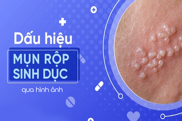 Nhận biết dấu hiệu mụn rộp sinh dục qua hình ảnh 